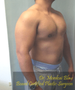 Pseudogynecomastia