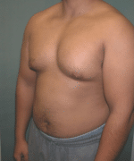 Pseudogynecomastia