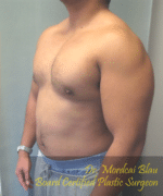 Pseudogynecomastia