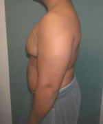 Pseudogynecomastia