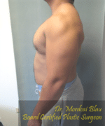 Pseudogynecomastia