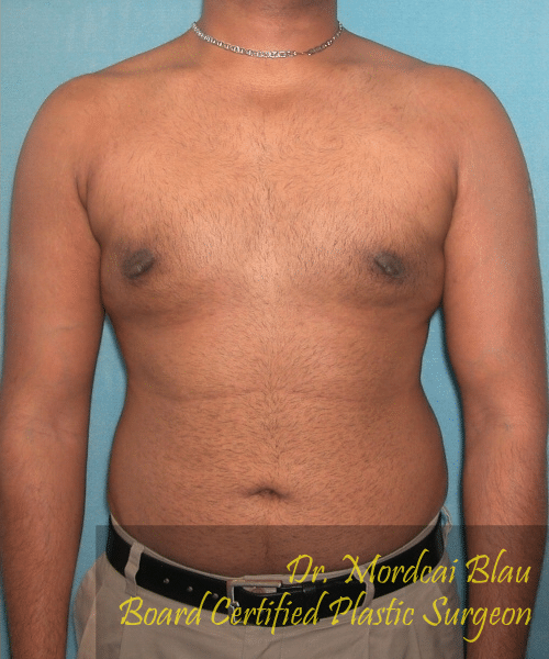 Pseudogynecomastia