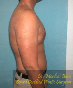 Pseudogynecomastia