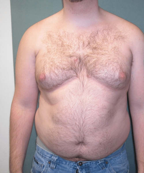 Pseudogynecomastia Before Photo Pseudogynecomastia