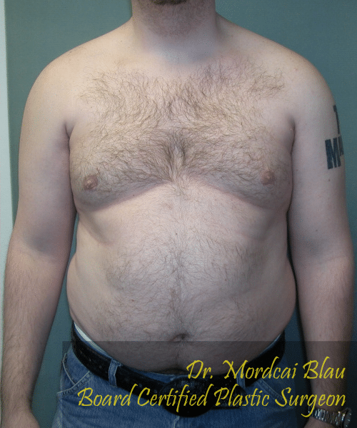 Pseudogynecomastia After Photo Pseudogynecomastia