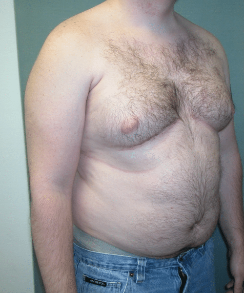 Pseudogynecomastia