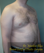 Pseudogynecomastia