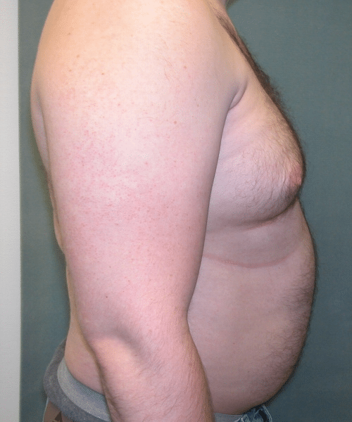 Pseudogynecomastia