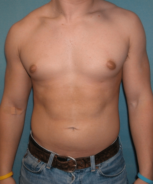 Pseudogynecomastia Before Photo Pseudogynecomastia