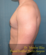 Pseudogynecomastia