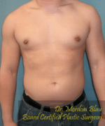 Pseudogynecomastia