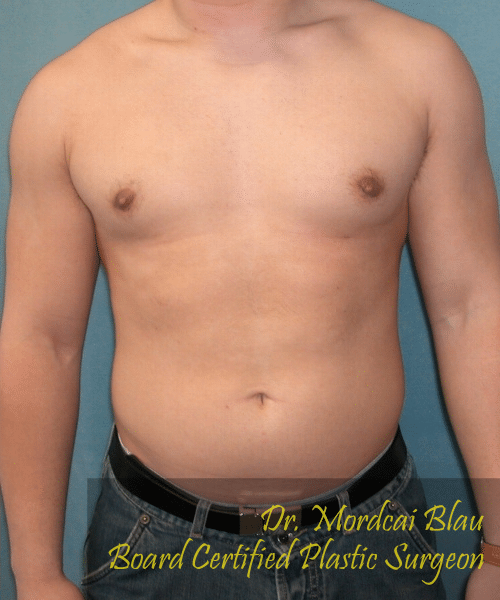 Pseudogynecomastia After Photo Pseudogynecomastia