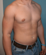 Pseudogynecomastia