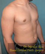 Pseudogynecomastia