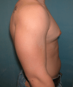 Pseudogynecomastia