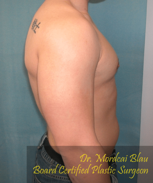 Pseudogynecomastia