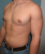 Pseudogynecomastia