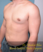 Pseudogynecomastia