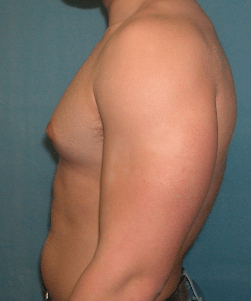 Pseudogynecomastia