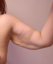 Arm Reduction (Brachioplasty) Before Photo Arm Reduction (Brachioplasty)