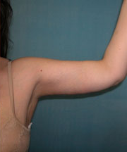 Arm Reduction (Brachioplasty) After Photo Arm Reduction (Brachioplasty)