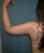 Arm Reduction (Brachioplasty)