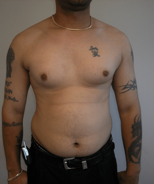 Pseudogynecomastia Before Photo Pseudogynecomastia