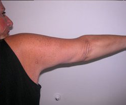 Arm Reduction (Brachioplasty) After Photo Arm Reduction (Brachioplasty)