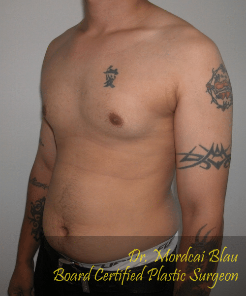 Pseudogynecomastia