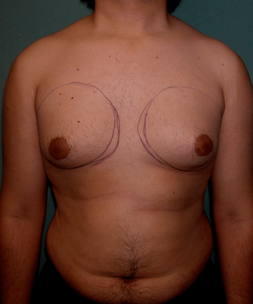Pseudogynecomastia Before Photo Pseudogynecomastia