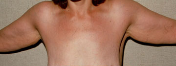 Arm Reduction (Brachioplasty)