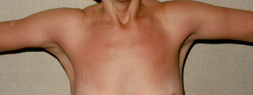 Arm Reduction (Brachioplasty) After Photo Arm Reduction (Brachioplasty)