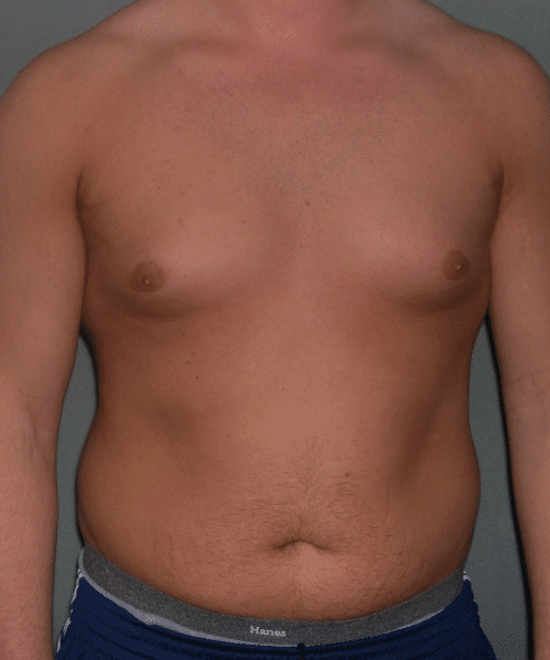 Pseudogynecomastia