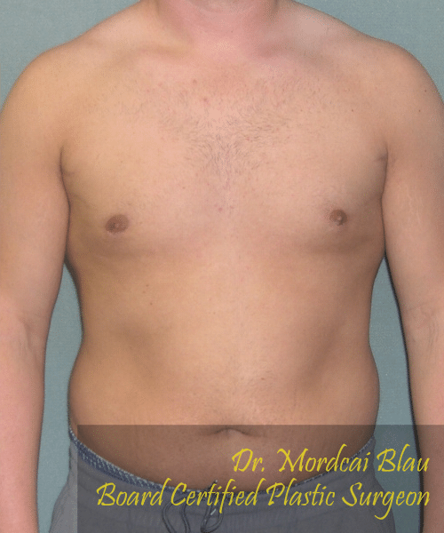 Pseudogynecomastia