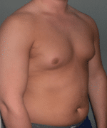 Pseudogynecomastia