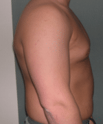 Pseudogynecomastia