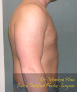 Pseudogynecomastia