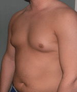 Pseudogynecomastia