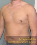 Pseudogynecomastia