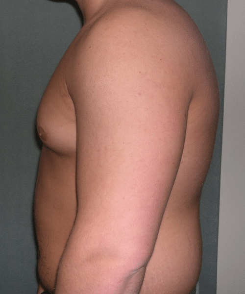 Pseudogynecomastia