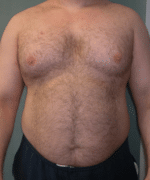 Pseudogynecomastia