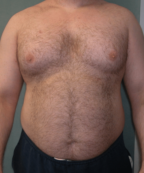 Pseudogynecomastia Before Photo Pseudogynecomastia