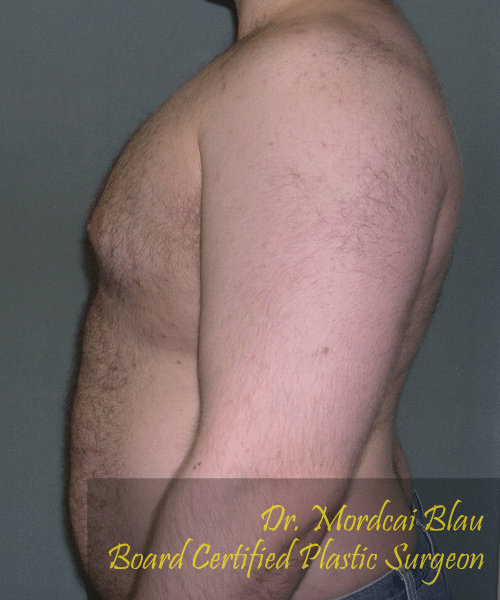 Pseudogynecomastia