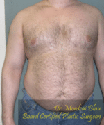 Pseudogynecomastia