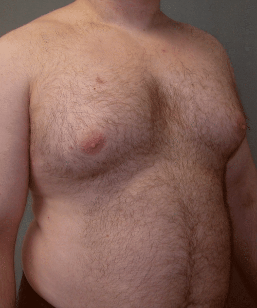 Pseudogynecomastia