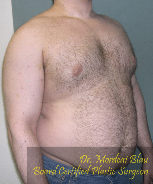 Pseudogynecomastia