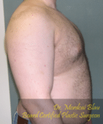 Pseudogynecomastia