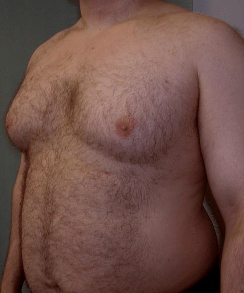 Pseudogynecomastia