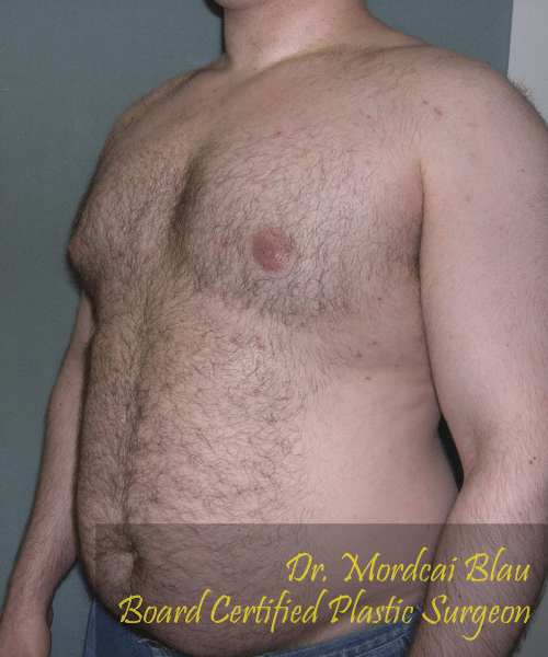 Pseudogynecomastia