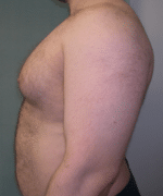 Pseudogynecomastia